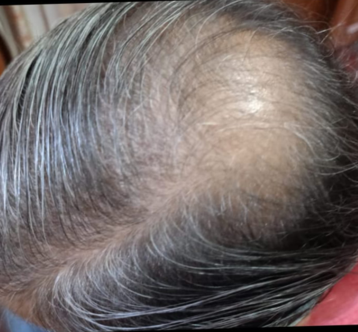 Read more about the article Hair Grown – Hair loss Treatment