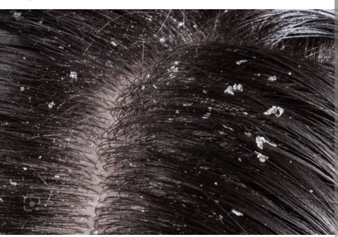 Read more about the article Hair Grown sa dandruff ka saffya ka sath strong hairs